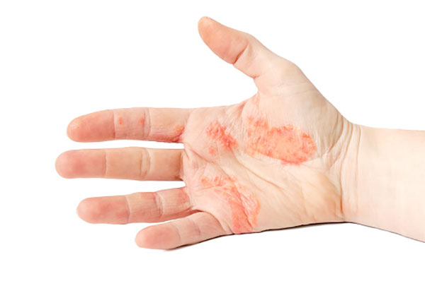 Chàm tổ đỉa là bệnh về da phổ biến thường xuất hiện ở bàn tay, bàn chân